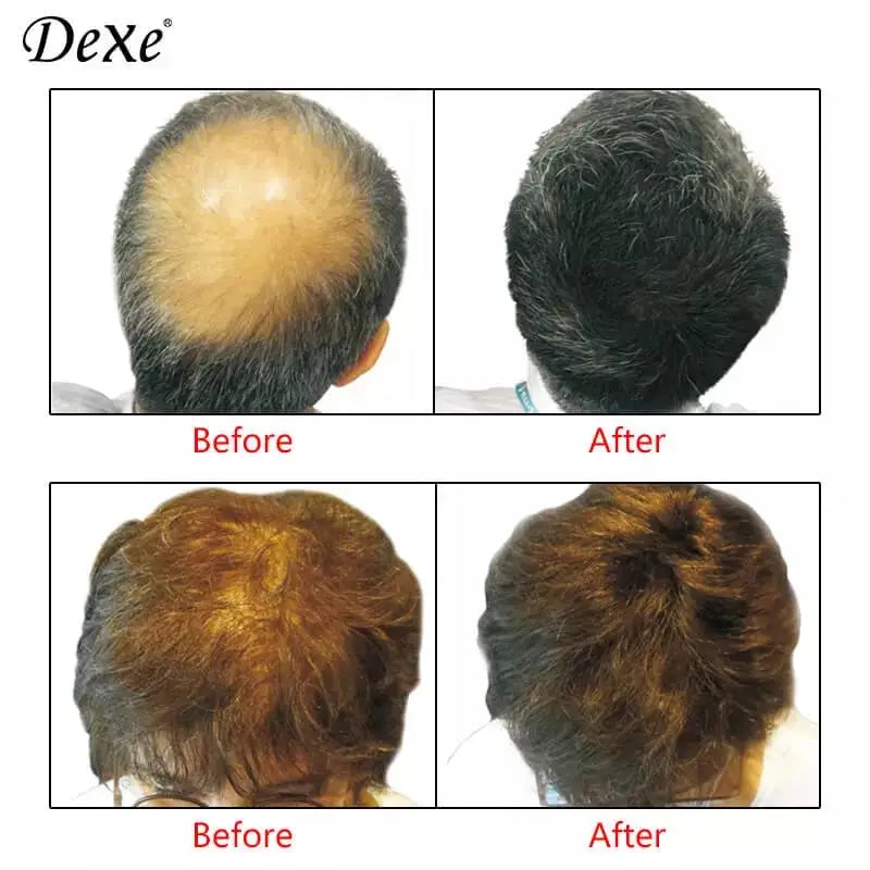 Dexe Hair Loss Concealer Building Fiber Kit - Hatke